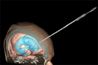 3D isosurfaces: skin, skull, brain and ventricles